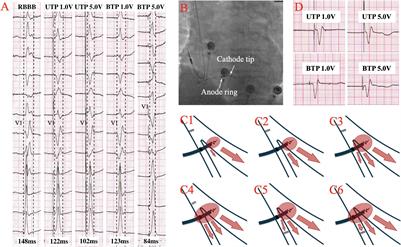 The Physiologic Mechanisms of Paced QRS Narrowing During Left Bundle Branch Pacing in Right Bundle Branch Block Patients